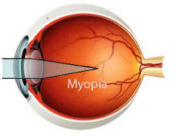 Myopia
