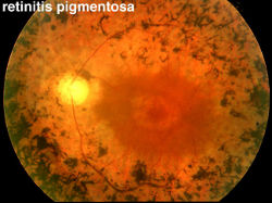 retinitis pigmentosa