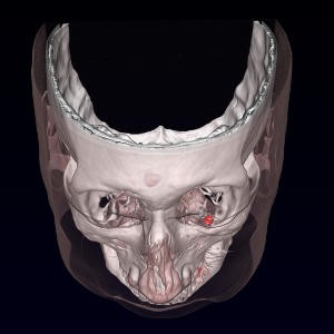 Magnetic Implants Used To Treat "Dancing Eyes"