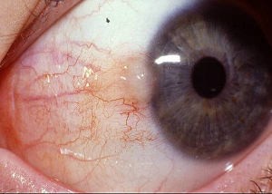 early pterygium