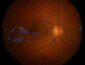 eye torn retina symptoms