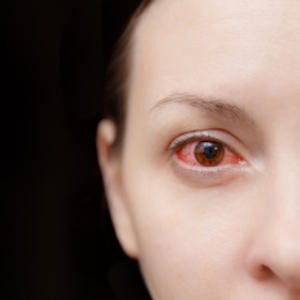 eye redness