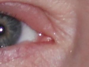 eye infection