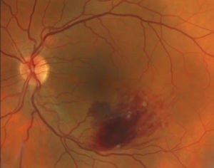 retinal vein occlusion