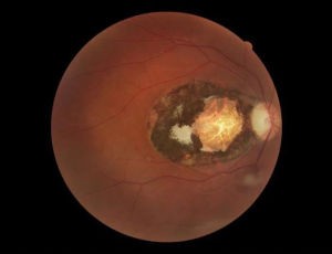 ocular toxoplasmosis