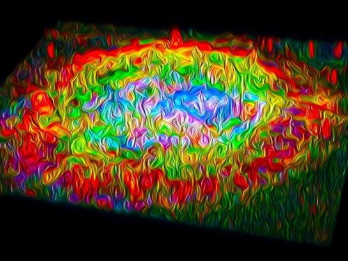 choroidal neovascular lesion