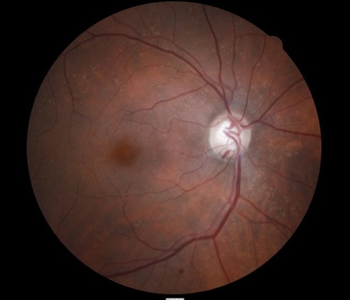 ACO Glaucoma