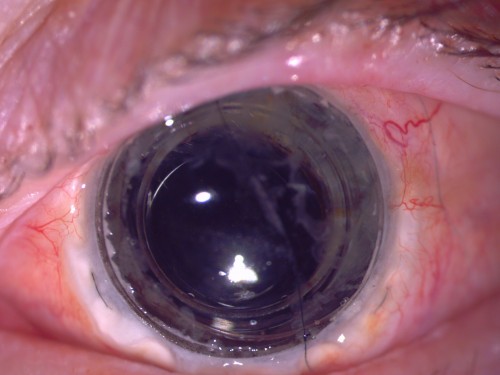 The patient eye following CorNeat KPro implantation 10-month post-op