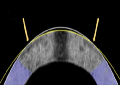 Laser less lasik