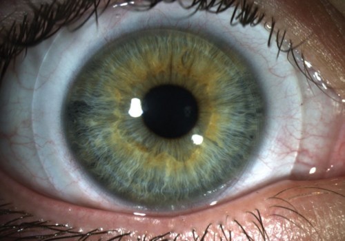 Mini-Scleral Lens ACO
