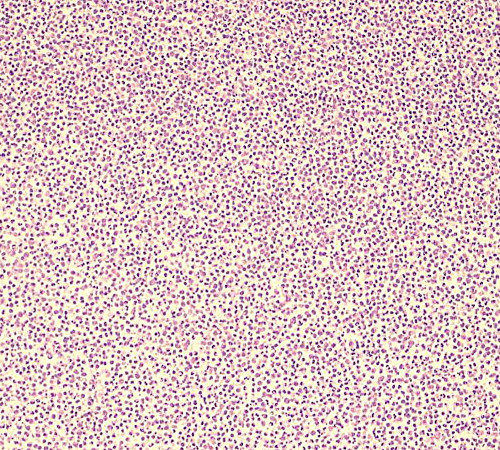 severe endophthalmitis