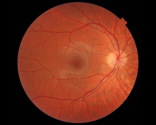 topcon fundus photo by julian